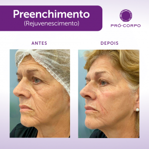 Preenchimento Bigode Chines Antes e Depois